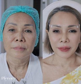 Vorher-nachher-Ergebnis Lip Lift bei Plenary Wellness, verbesserte Lippenkontur, jüngeres Aussehen