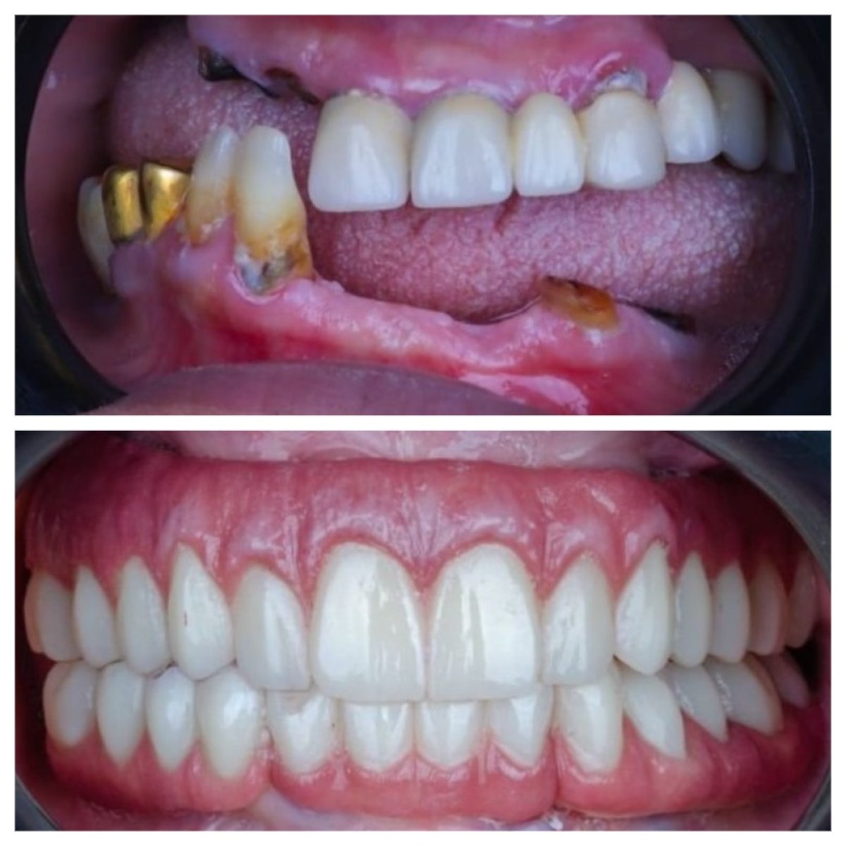 Resultados antes y después de implantes All-on-6 en Omara Dental Centers, restauración total