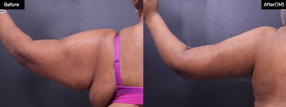 Résultats avant/après liposuccion des bras chez VG Plastic Surgery – bras affinés