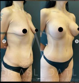 Vorher-nachher-Ergebnisse Brustvergrößerung und Bauchdeckenstraffung Liv Hospital Ulus