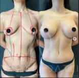 Vorher-nachher-Ergebnisse Brustvergrößerung und Bauchdeckenstraffung Liv Hospital Ulus