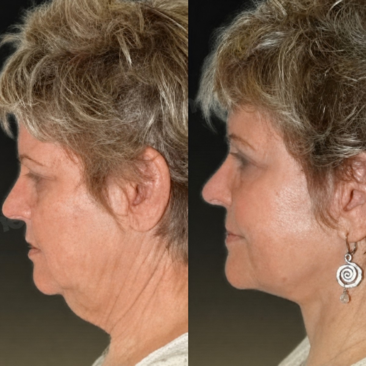Resultados de minilifting facial antes y después en Memorial Antalya Hospital, mejora del contorno