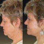 Before and after mini facelift results at Memorial Antalya Hospital, visible jawline improvement