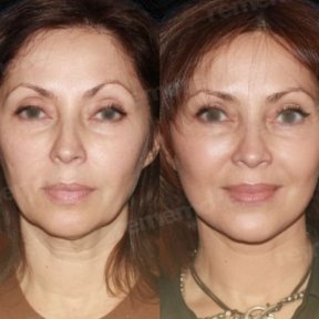 Before and after mini facelift results at Memorial Antalya Hospital, facial rejuvenation visible
