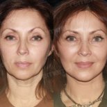 Before and after mini facelift results at Memorial Antalya Hospital, facial rejuvenation visible