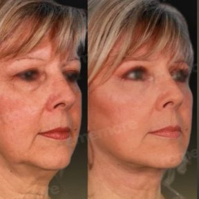 Before and after mini facelift results at Memorial Antalya Hospital, visible facial rejuvenation