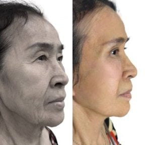 Facelift before and after results at Yanhee International Hospital, visible facial rejuvenation