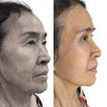 Facelift before and after results at Yanhee International Hospital, visible facial rejuvenation