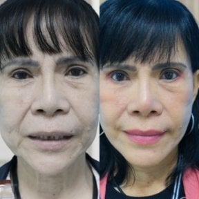 Résultats lifting visage avant/après à Yanhee International Hospital, rajeunissement visible