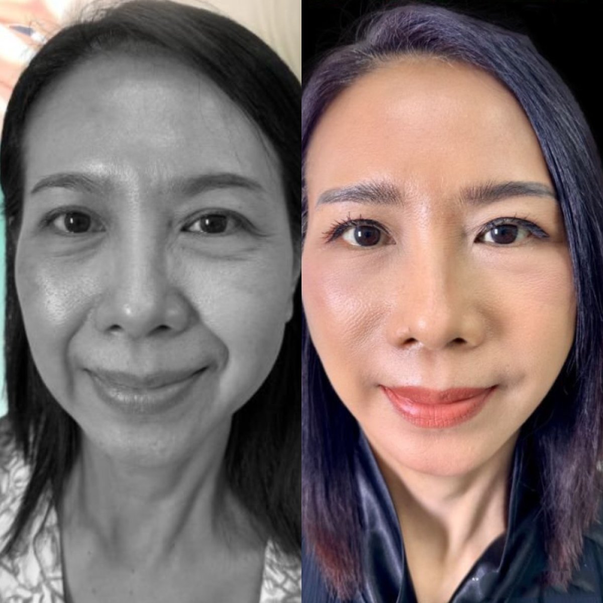 Resultados de lifting facial antes y después en Yanhee International Hospital, rejuvenecimiento
