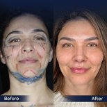 Brow Lift Vorher-Nachher-Ergebnis in der Dr. Safa Manav Klinik, sichtbare Verjüngung