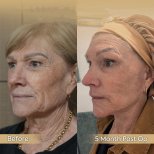 Vorher-nachher-Ergebnis Brauenlifting in der Dr. Safa Manav Klinik, sichtbare Stirnstraffung