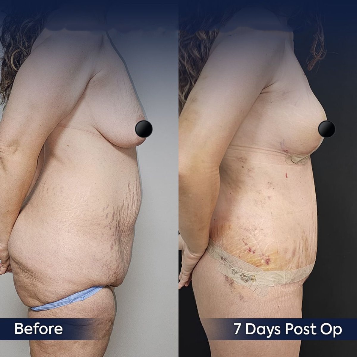 Before and after arm lift (brachioplasty) results at Dr. Safa Manav Clinic, visible contour change