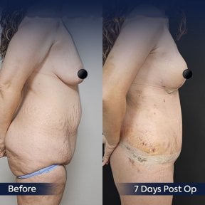 نتائج شد الذراعين قبل وبعد في عيادة Dr. Safa Manav، تغير واضح في شكل الذراع