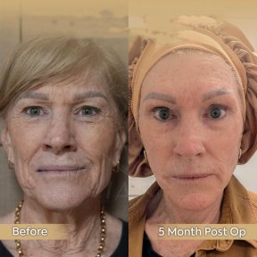 Facelift Vorher-Nachher-Ergebnis in der Dr. Safa Manav Klinik, sichtbare Verjüngung
