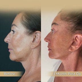 Facelift Vorher-Nachher-Ergebnisse in der Dr. Safa Manav Klinik, sichtbare Verjüngung