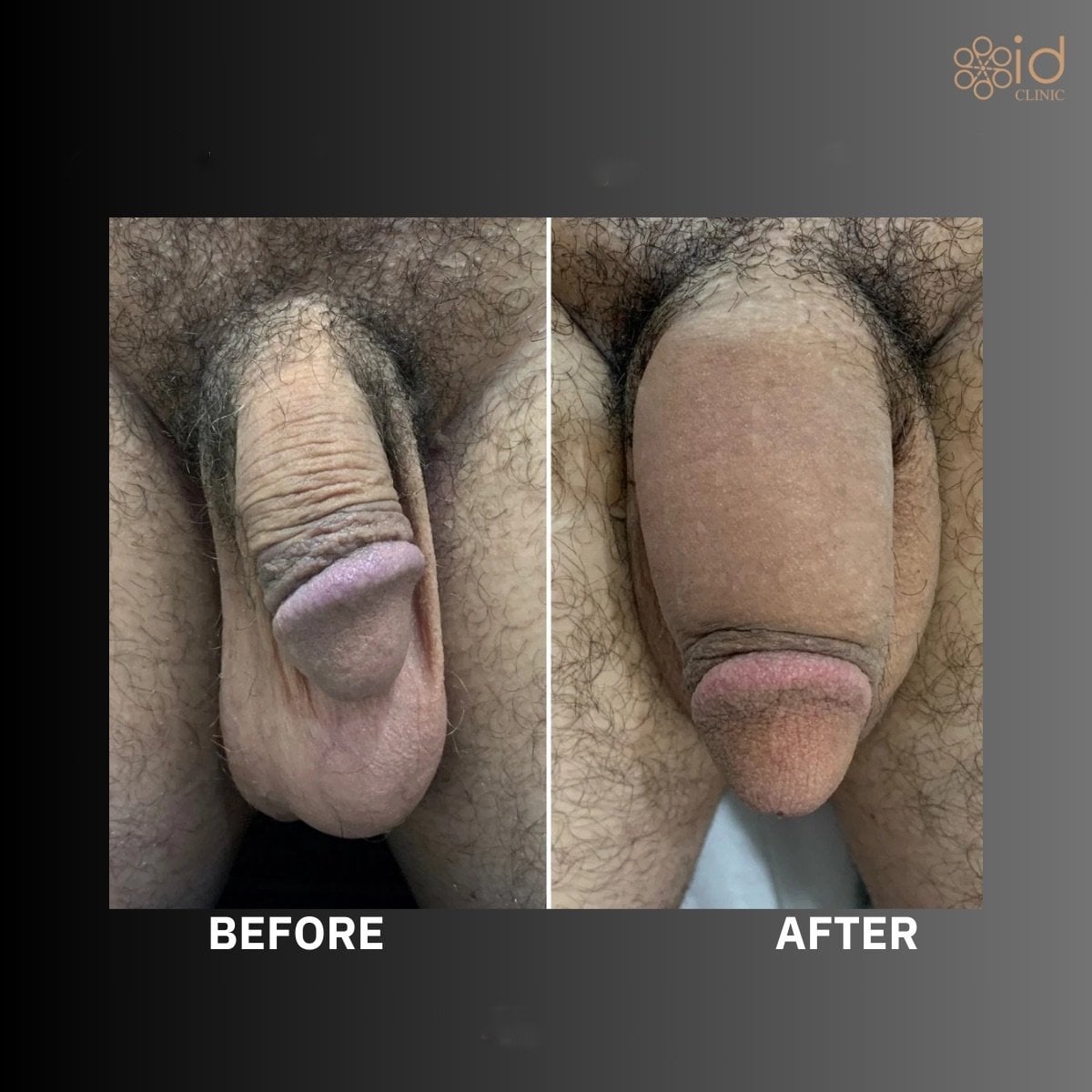 Resultados antes y después de PRP genital (O-Shot) en ID Clinic Bangkok, mejora visible