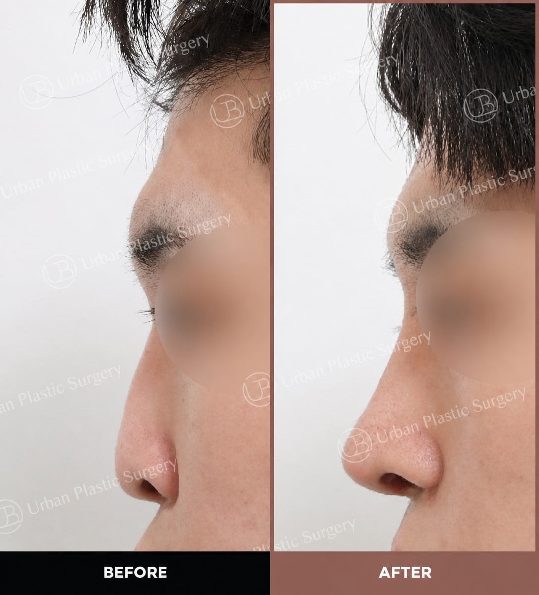 نتائج قبل وبعد عملية تجميل الأنف المفتوحة في URBAN Plastic Surgery، تحسين شكل الأنف