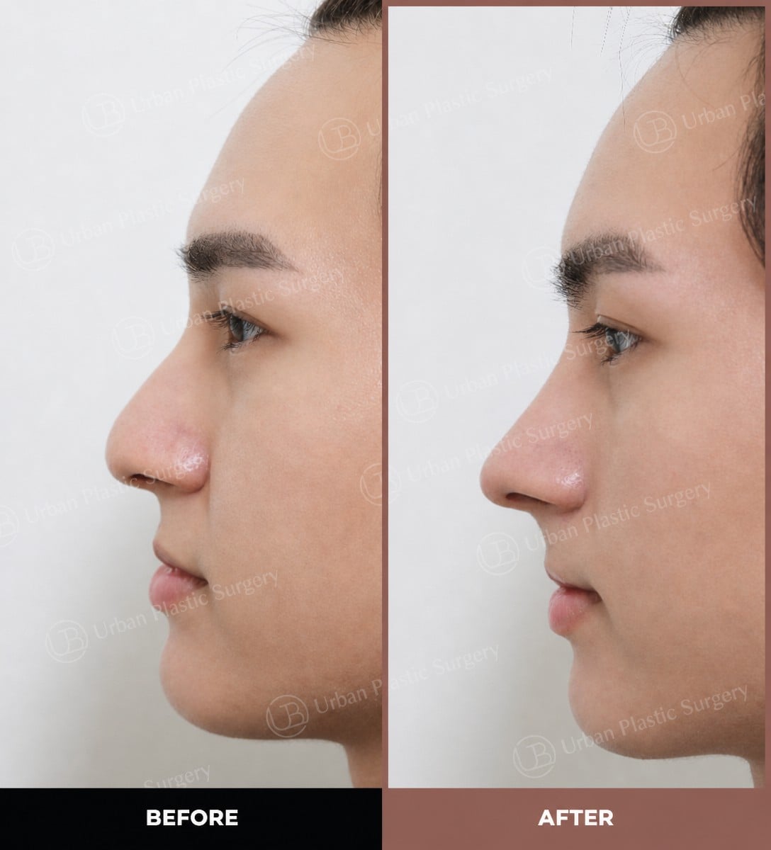 نتائج قبل وبعد عملية تجميل الأنف المفتوحة في URBAN Plastic Surgery، تحسين شكل الأنف
