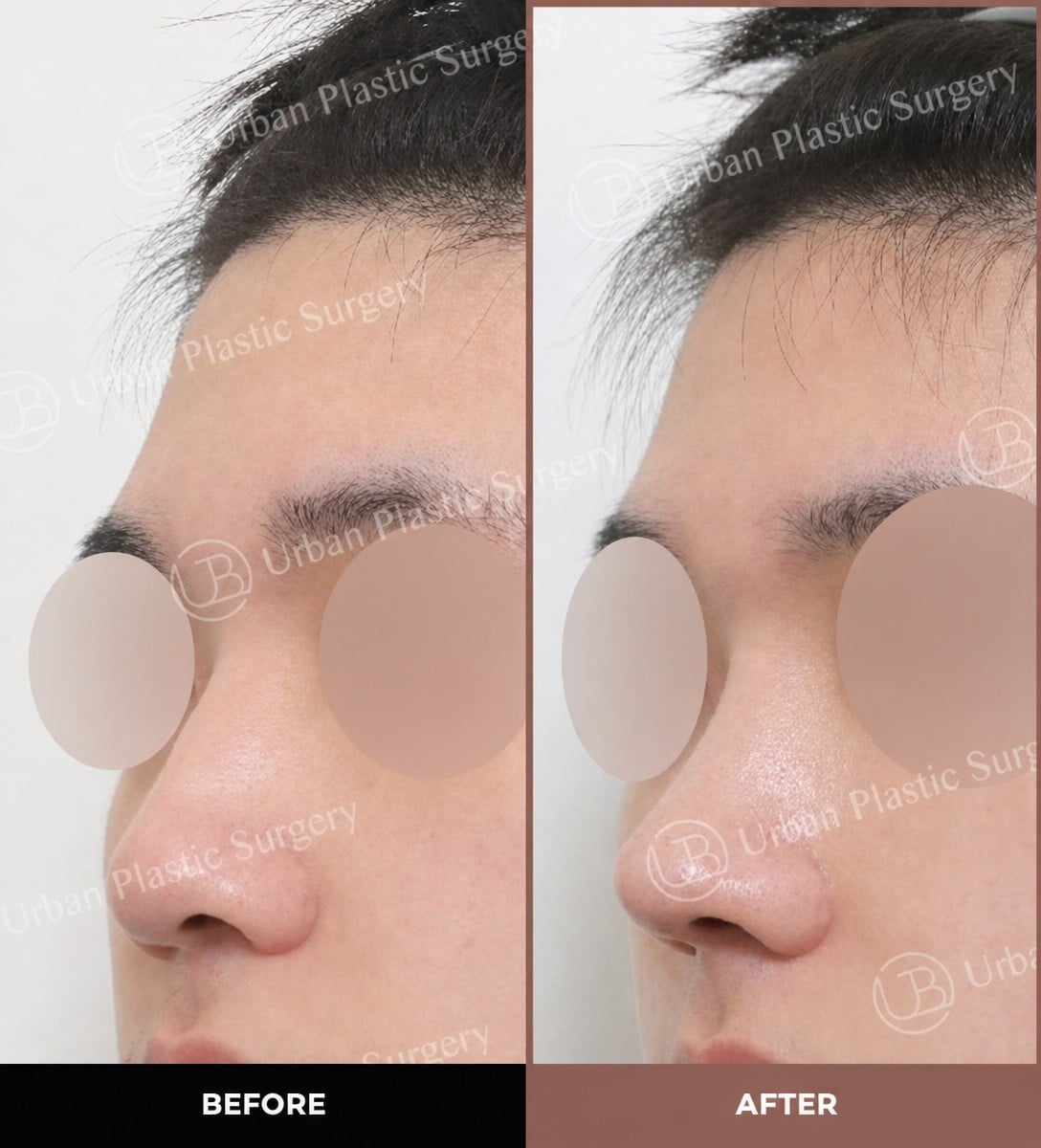 نتائج قبل وبعد عملية تجميل الأنف المفتوحة في URBAN Plastic Surgery، إعادة تشكيل الأنف