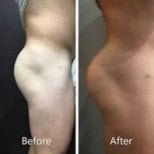 Resultados antes y después de Brazilian Butt Lift en ID Clinic Bangkok, glúteos realzados