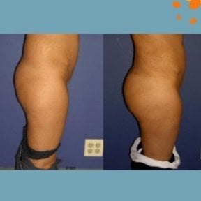 Resultados antes y después de Brazilian Butt Lift en ID Clinic Bangkok, glúteos realzados