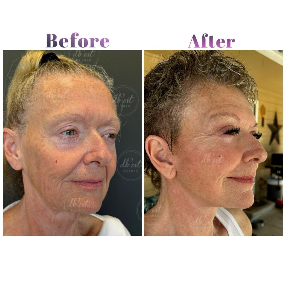 Resultados de lifting de cejas antes y después en Db'est Clinic, rejuvenecimiento visible