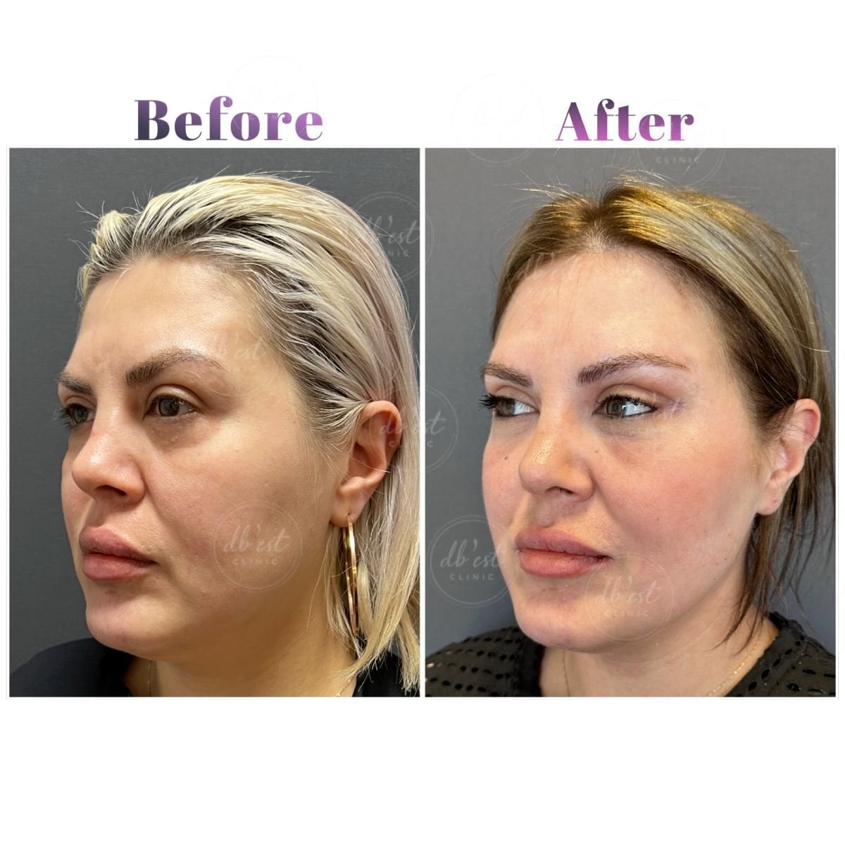 Resultados de lifting de cejas antes y después en Db'est Clinic, elevación visible de cejas