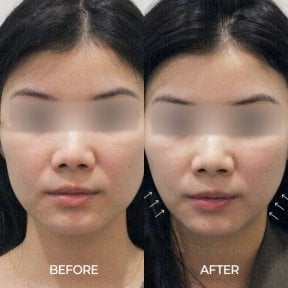 До и после лазерной шлифовки кожи в Forena Clinic, улучшение текстуры лица