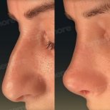 Before and after tip rhinoplasty results at Memorial Şişli Hospital, refined nose shape