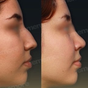Résultats avant et après rhinoplastie de la pointe au Memorial Şişli Hospital, nez affiné