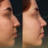 Résultats avant et après rhinoplastie de la pointe au Memorial Şişli Hospital, nez affiné
