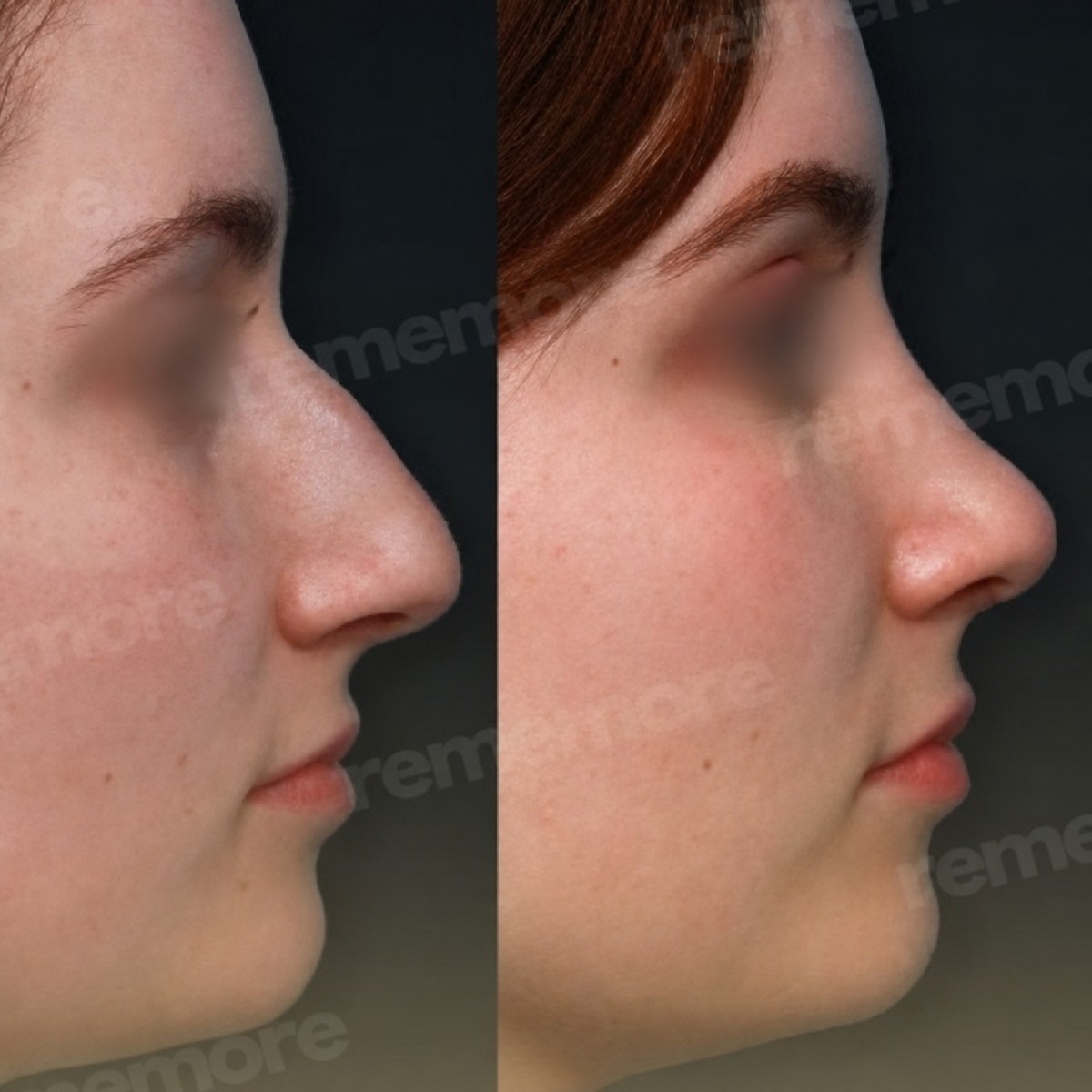 نتائج قبل وبعد تجميل طرف الأنف في مستشفى ميموريال شيشلي، شكل أنف محسّن