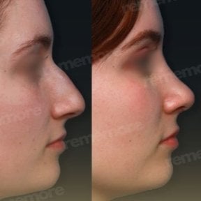 Résultats avant et après rhinoplastie de la pointe au Memorial Şişli Hospital, nez affiné