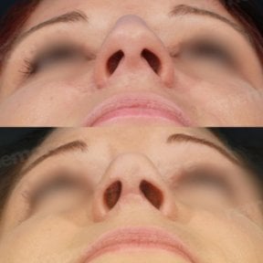 Résultat avant/après rhinoplastie de la pointe au Memorial Şişli Hospital, pointe affinée