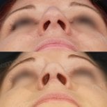 Résultat avant/après rhinoplastie de la pointe au Memorial Şişli Hospital, pointe affinée
