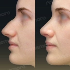 Résultats avant/après rhinoplastie de la pointe au Memorial Şişli Hospital, nez affiné