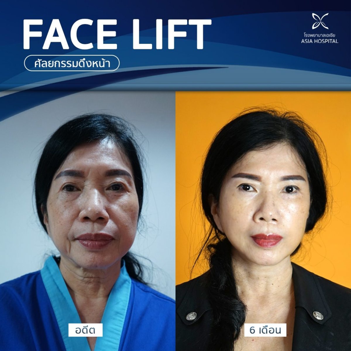 Результаты до и после подтяжки лица в Asia Cosmetic Hospital – омоложение лица