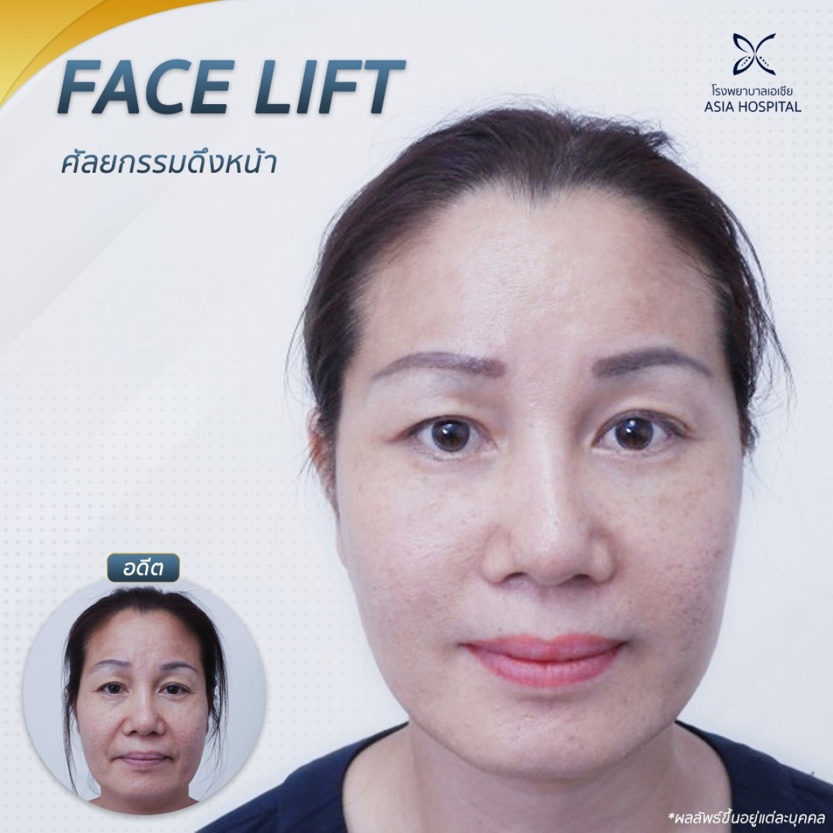 Результаты до и после подтяжки лица в Asia Cosmetic Hospital, омоложение лица