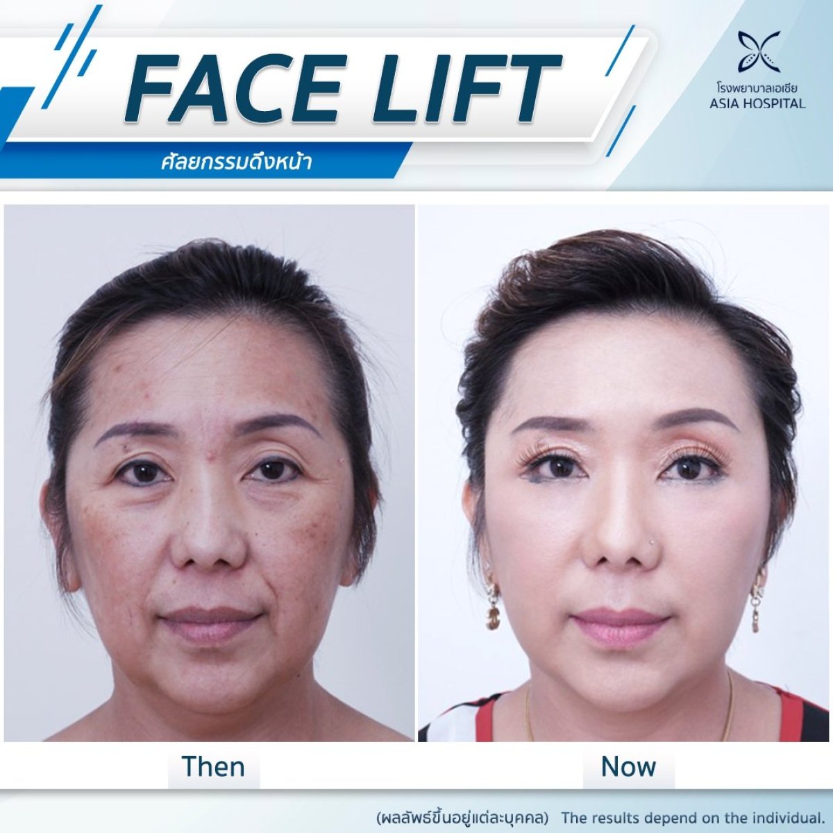 Результаты до и после подтяжки лица в Asia Cosmetic Hospital, омоложение лица