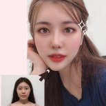 Результаты до и после открытой ринопластики в VG Plastic Surgery, улучшенная форма носа