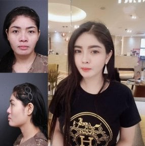 Результаты до и после открытой ринопластики в VG Plastic Surgery, улучшение гармонии лица