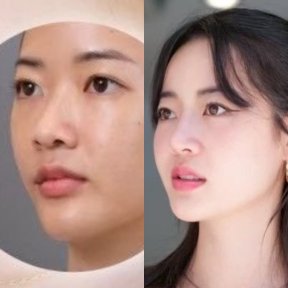 Before and after rhinoplasty results at Dr. Chen Surgery Hospital International Center, nose reshaping