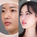 Before and after rhinoplasty results at Dr. Chen Surgery Hospital International Center, nose reshaping