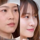 Before and after rhinoplasty results at Dr. Chen Surgery Hospital International Center, nose reshaping