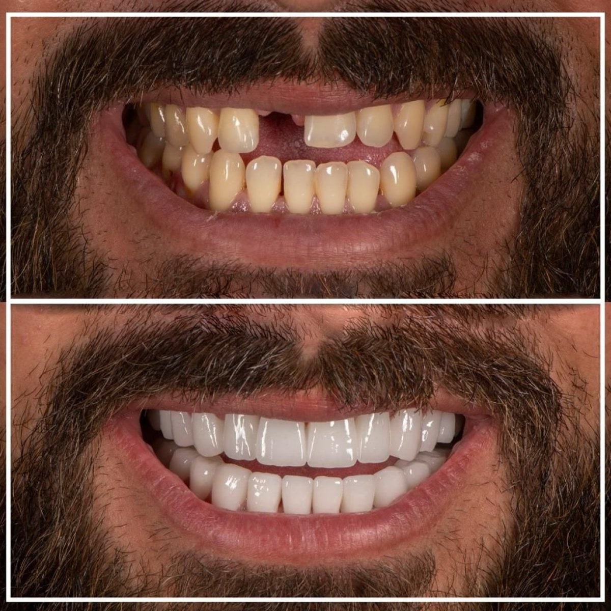 نتائج قبل وبعد خلع الأسنان في My Nova Kusadasi Dental Clinic، ابتسامة محسنة