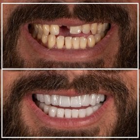 Before and after tooth extraction results at My Nova Kusadasi Dental Clinic, improved smile