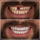 Before and after tooth extraction results at My Nova Kusadasi Dental Clinic, improved smile