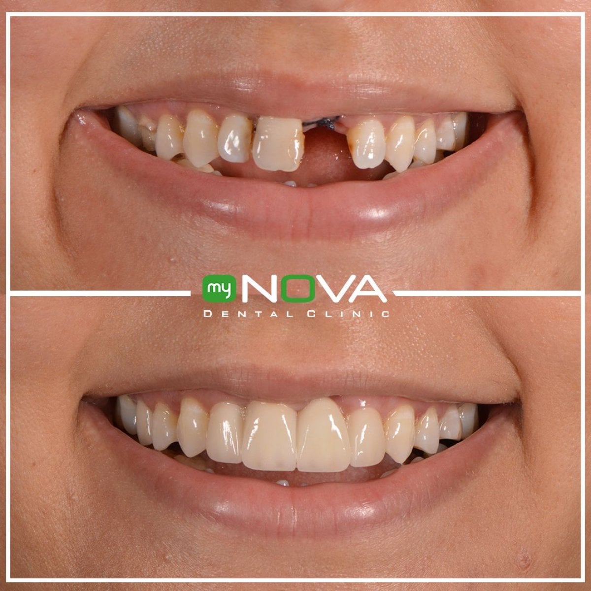 نتائج قبل وبعد خلع الأسنان في My Nova Kusadasi Dental Clinic، ابتسامة محسنة