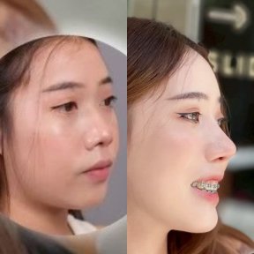 Before and after rhinoplasty result at Dr. Chen Surgery Hospital International Center, nose reshaping